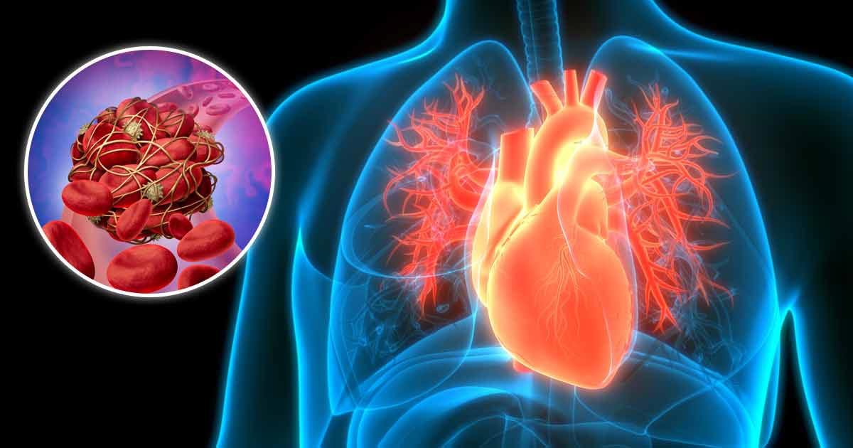 Coágulos sanguíneos podem ser a principal causa de todas as doenças cardíacas