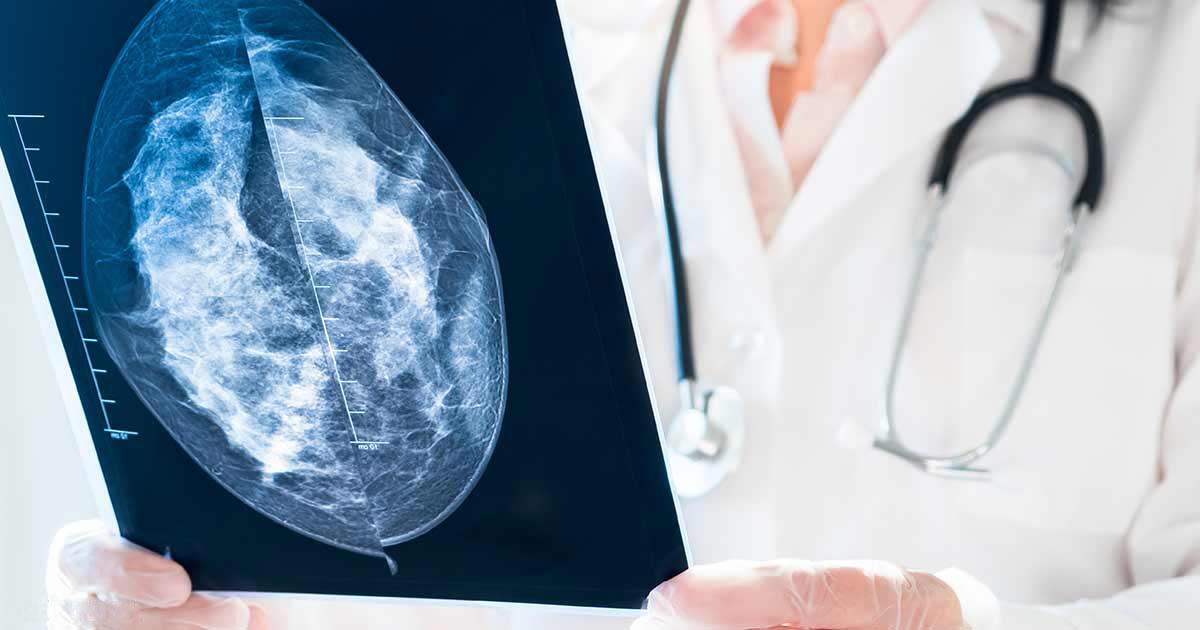 Das mulheres, 50% tiveram uma mamografia falso-positiva após 10 anos