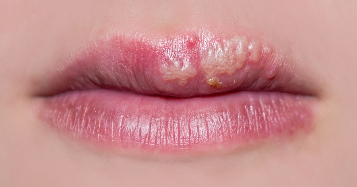 Óleo da árvore do chá para verrugas e herpes labial