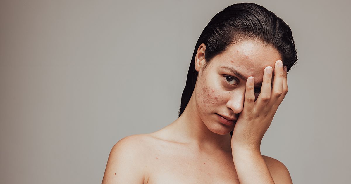 Como você trata a acne de forma natural?