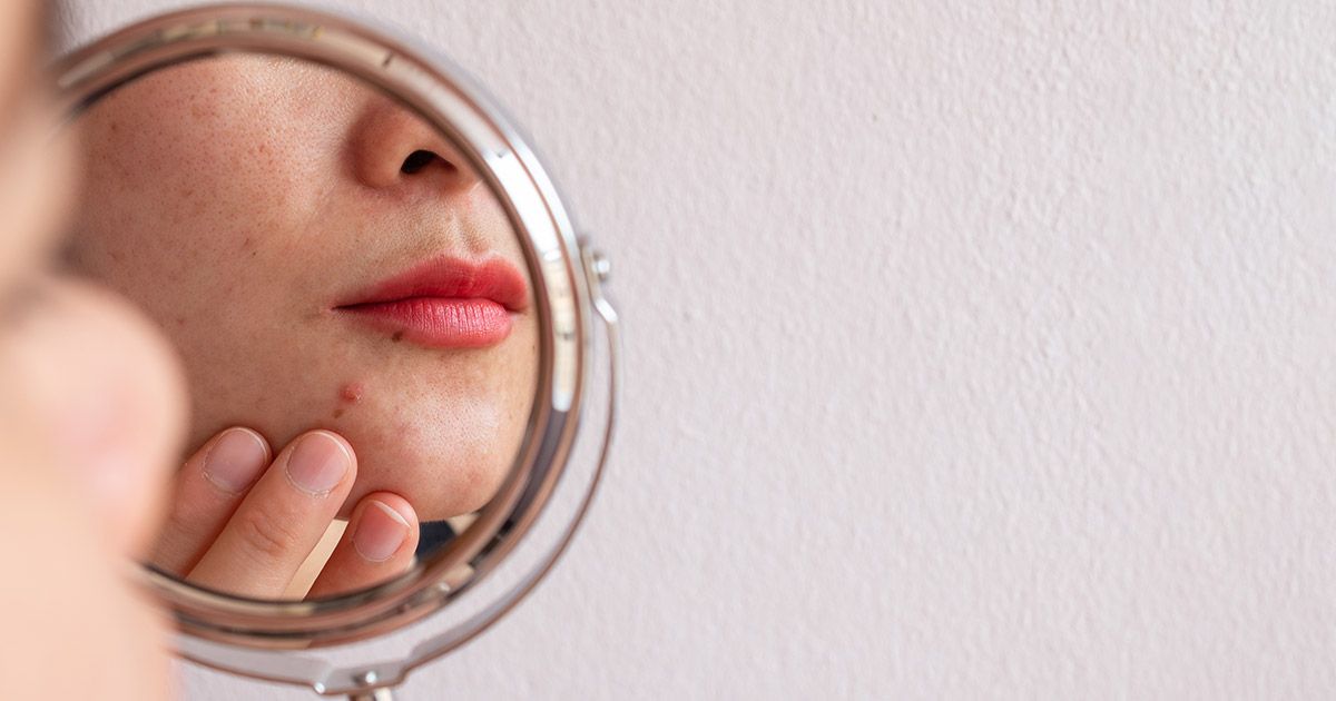 Como se livrar das cicatrizes de acne