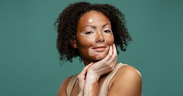 Como você pode ajudar no controle do vitiligo de maneira natural?