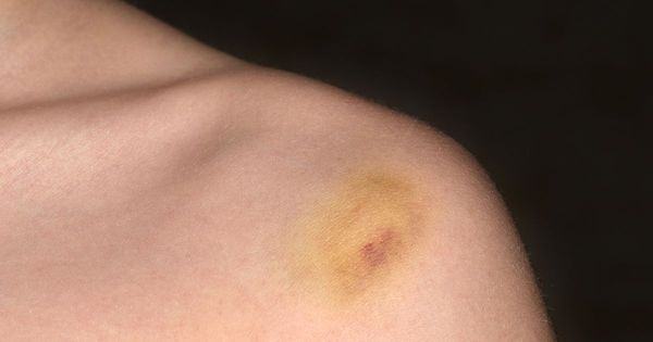 Esse tipo de hematoma deveria preocupar você?