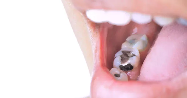 Amálgamas dentários tóxicos estão para ser proibidos na União Europeia