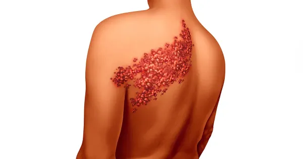 Como saber a diferença entre herpes e herpes zoster